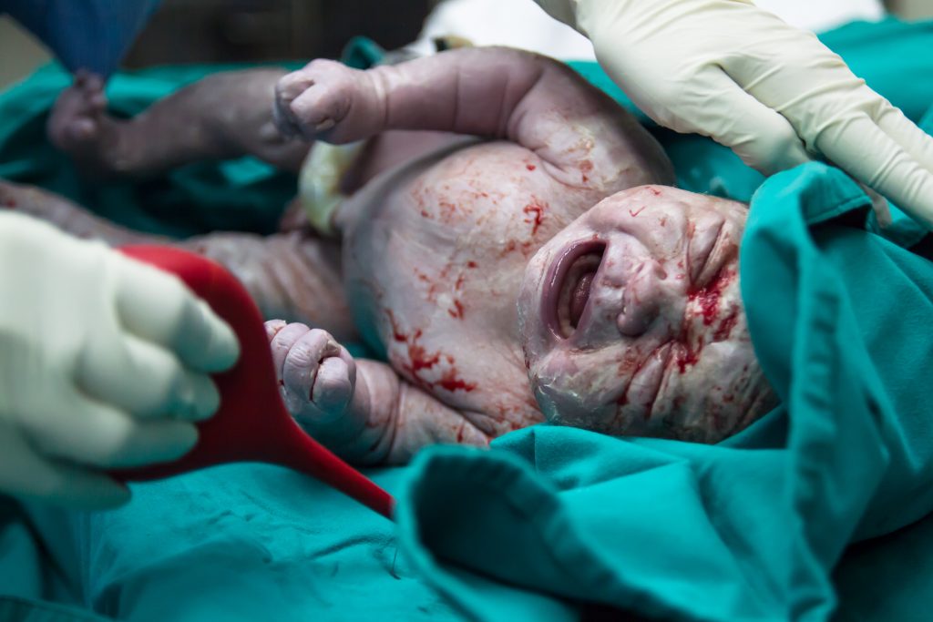 Cesarean Birth